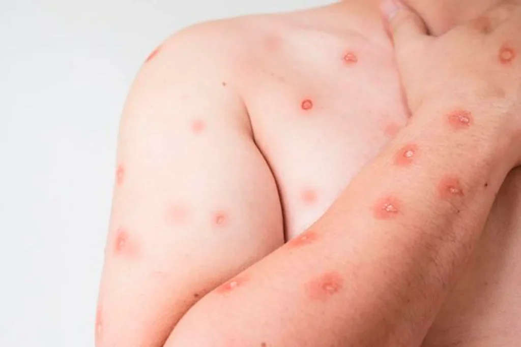 Bahia Confirma Dois Casos de Mpox e Sesab Investiga Novas Suspeitas em 2026