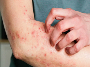 Bahia Registra 7 Casos Suspeitos de Mpox, Sem Mortes Confirmadas