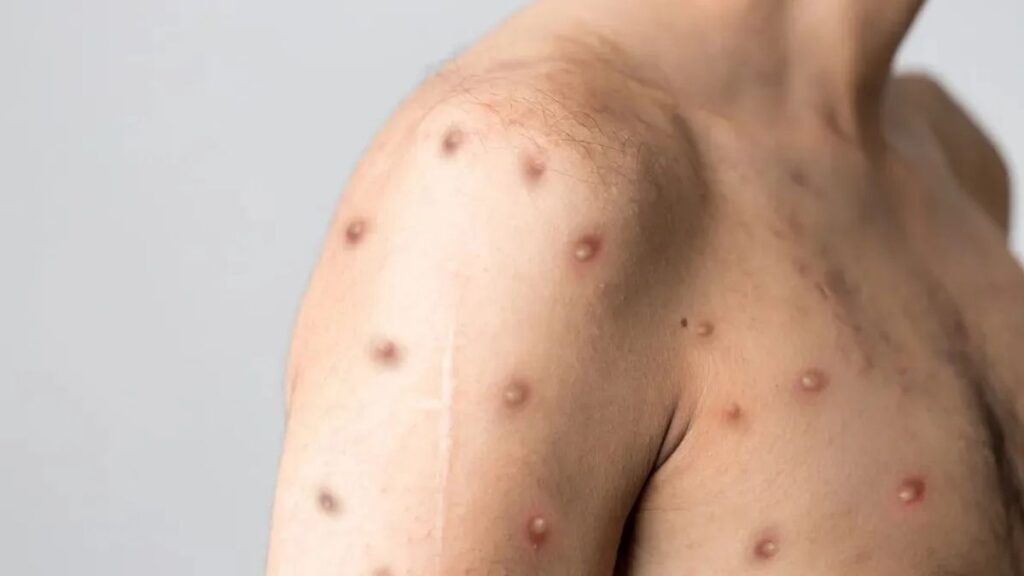 Mpox na Bahia: Casos Confirmados e Informações Atualizadas